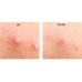 Пластыри для лица от воспалений Pyunkang Yul Acne Spot Patch Super Thin 15 шт