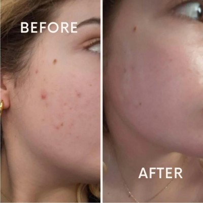 Гіалуронова сироватка для обличчя з азелаїновою кислотою Anua Azelaic Acid 10 Hyaluron Redness Soothing Serum, 30ml