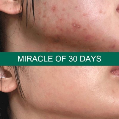 Олія чайного дерева для обличчя SOME BY MI 30 Days Miracle Tea Tree Clear Spot Oil, 10 мл